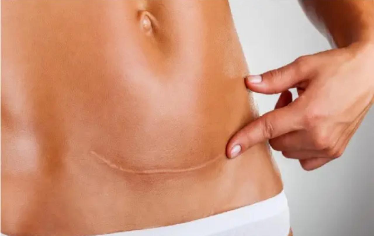 Recovery Anti-Fibrose – Tratamento de Fibroses JOHARI